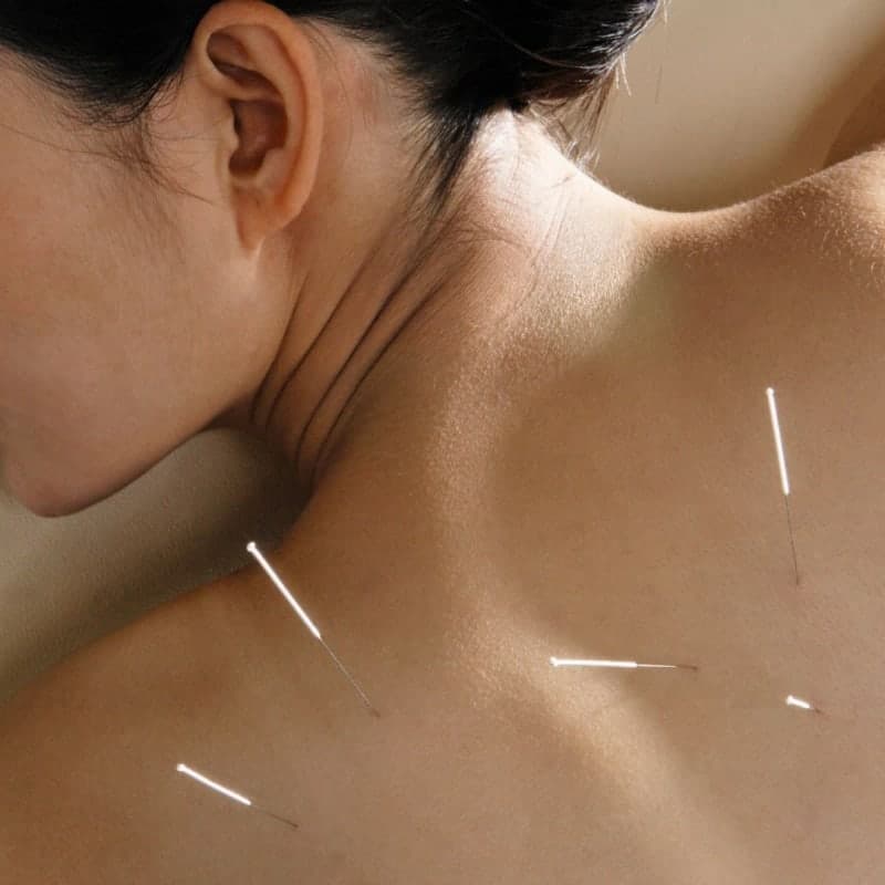 Acupuncture